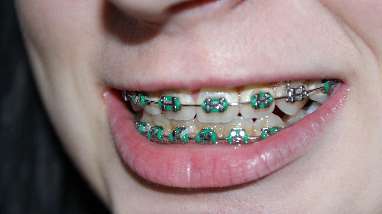 Worden je lippen dunner als je beugel eruit gaat? Dit zeggen experts